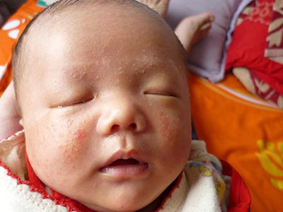 寶寶濕疹要怎麼護理 寶寶濕疹吃什麼好