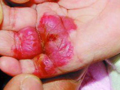 警惕新生兒紅色胎記 可能是血管瘤