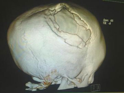 泸州男孩出生1月頭骨摔破 4年後長成大洞