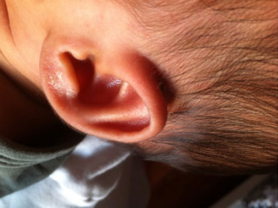 3歲孩子感染"4S”病毒 耳朵長疱用手一搓就掉皮