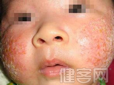 兒童異位性皮炎 嬰兒期的異位性皮炎有什麼特征