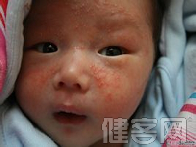 小兒濕疹的原因和症狀有哪些？