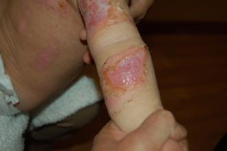 小兒燒傷燙傷原因和針對性護理