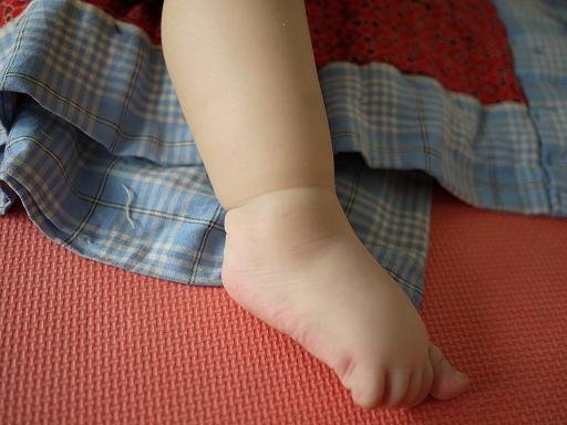 兒童踝關節扭傷怎麼急救