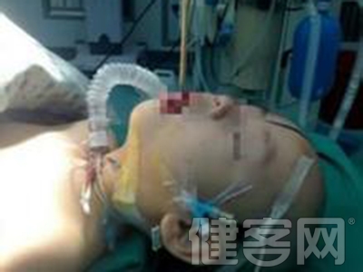 男孩跌倒筷子插腦 醫生妙手解救