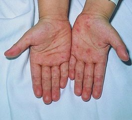 手足口病的預防與治療