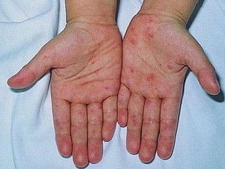 孩子出疹子發燒當心手足口病