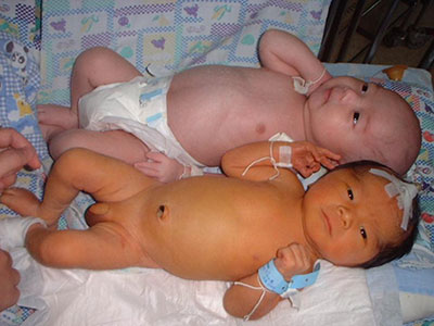 新生兒黃疸分為生理性和病理性兩種