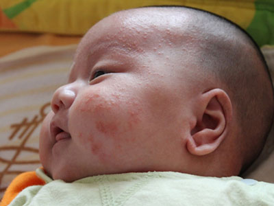 寶寶臉上長濕疹如何應對
