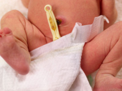 新生兒常見臍帶疾病及處理
