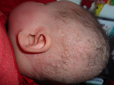 寶寶濕疹你知道怎麼治療嗎？