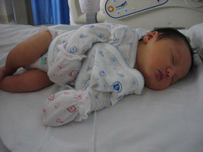 小兒疝氣可使用單孔腹腔鏡治療