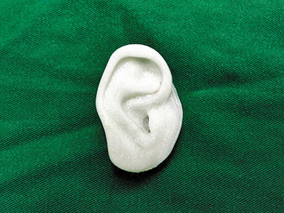 3D打印將助女童長出新耳