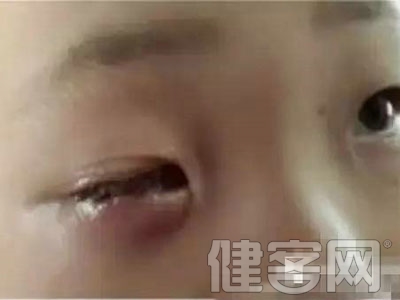 5歲男童玩干燥劑把眼睛炸傷 眼珠被溶解