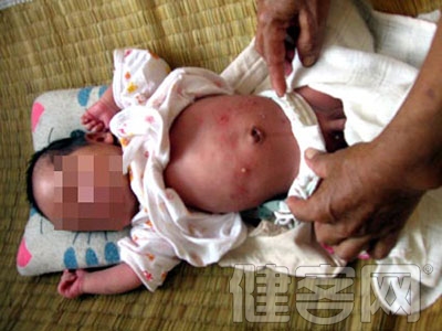 什麼是新生兒膿疱疹?