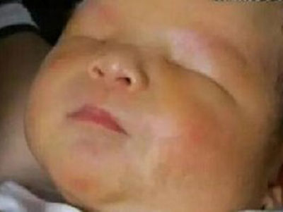 廣州女子生出沒眼睛嬰兒 專家:是罕見的基因疾病