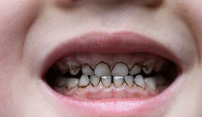為什麼寶寶的牙齒總是黑黑的？因為...
