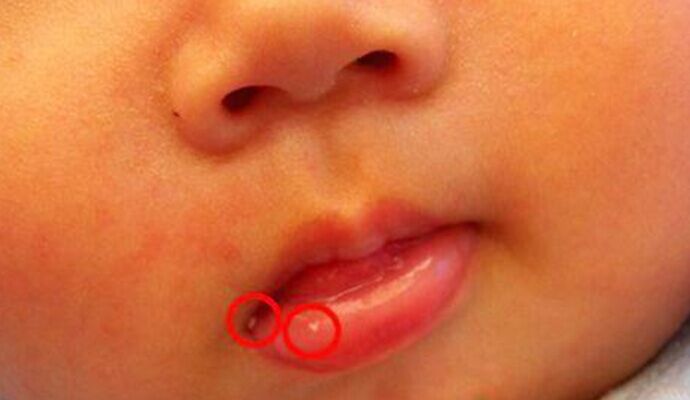 秋季爛嘴角高發  寶寶爛嘴角如何護理？