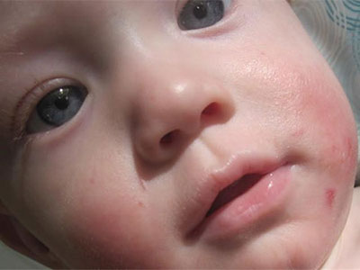 寶寶奶癬濕疹的原因