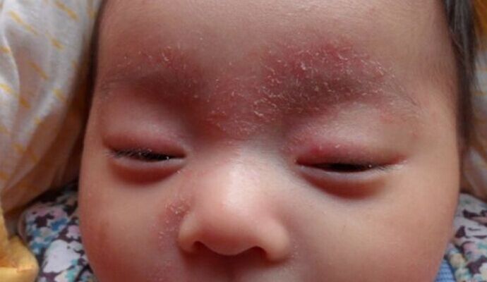 是什麼引來了嬰兒濕疹？