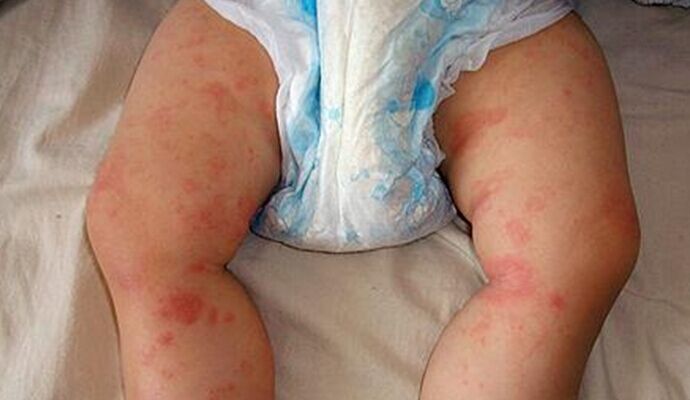 是什麼引來了嬰兒濕疹？