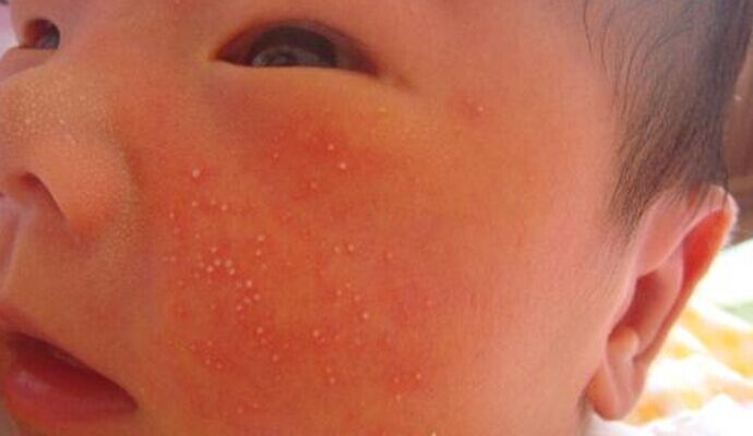 新生兒濕疹怎麼辦  4種治療方法推薦