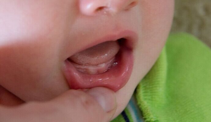 寶寶長牙發燒？口腔的問題
