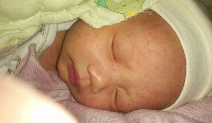新生寶寶臉上長小紅點可考慮三種原因