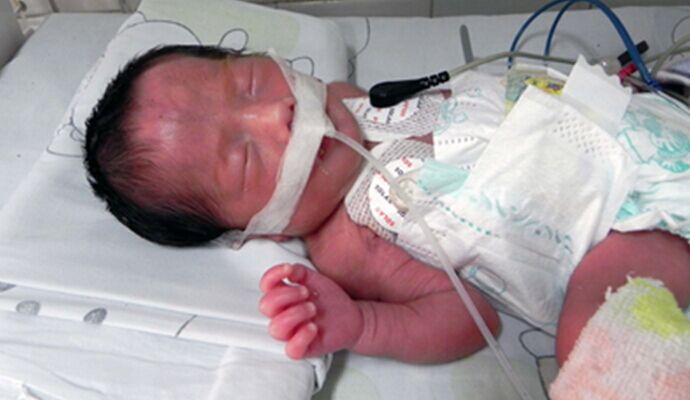 新生兒窒息復蘇後如何護理？