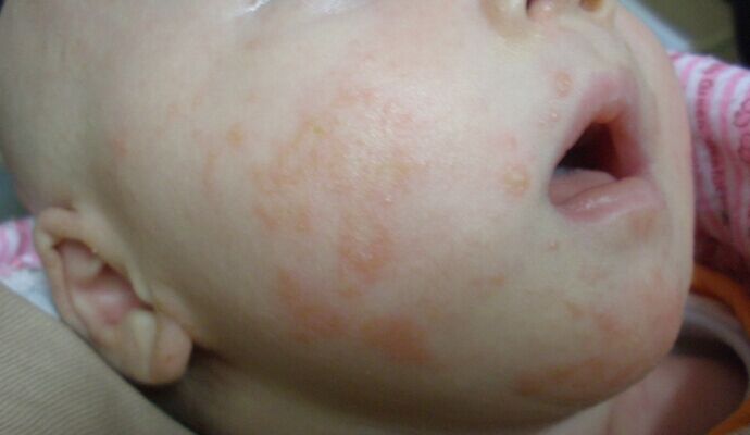 寶寶臉上起濕疹怎麼辦 護理要得當