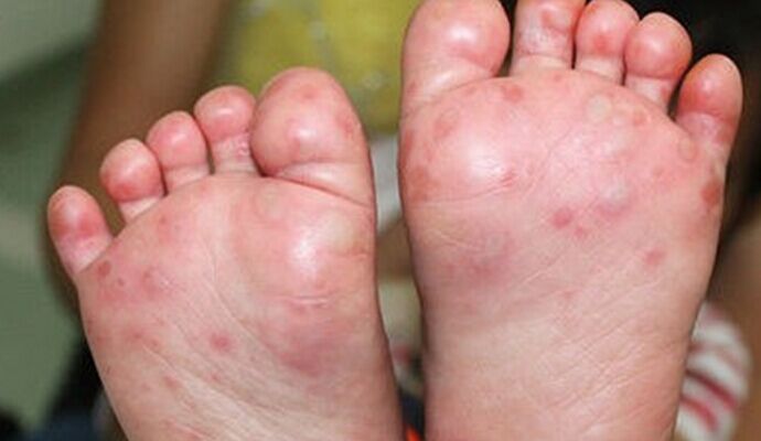 健康百科：小兒手足口病症狀有哪些