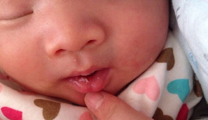 寶寶口瘡到底是什麼原因呢？