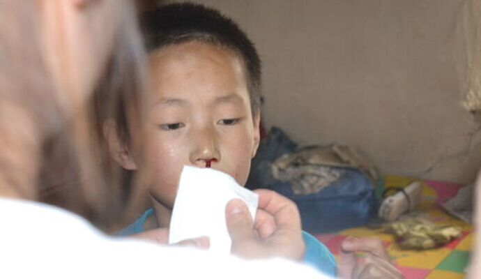 育兒須知：兒童鼻出血的護理