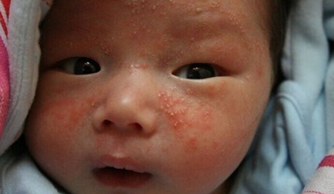 治療嬰兒濕疹的偏方