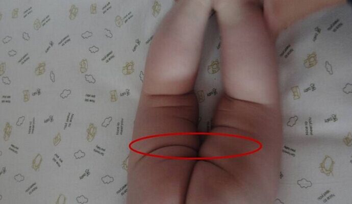 寶寶體檢看臀紋 臀紋不對稱好還是不好呢？