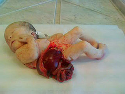 女嬰腹裂症腸子露體外 身上裹保鮮膜保命