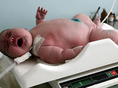 120公斤胖媽剖腹產下4.3公斤巨嬰 寶寶出生血糖為零