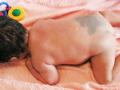 寶寶胎記會影響健康嗎 胎記類型有哪些