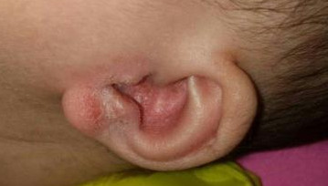 警惕！寶寶抓耳撓腮易患中耳炎？