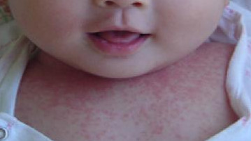 教你辨別寶寶是濕疹還是痱子