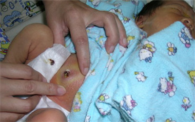 新生寶寶臍帶護理注意事項