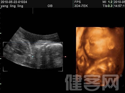 四維彩超拍“萌照” 小心胎兒吃射線