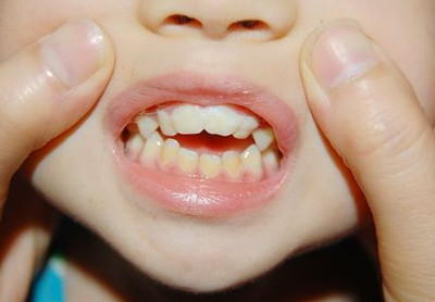答疑解惑：牙齒真的會遺傳嗎？
