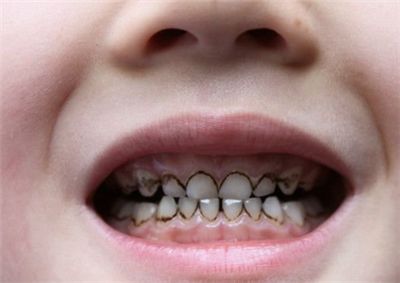 兒童患上齲齒應該如何治療