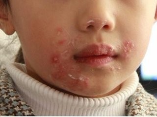 小兒濕疹應該怎麼治療