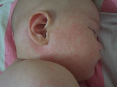小兒麻疹疾病如何進行護理