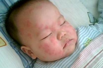 怎麼正確識別小兒荨麻疹
