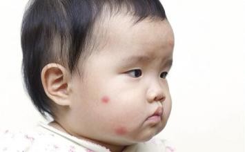 寶寶得了濕疹怎麼治療